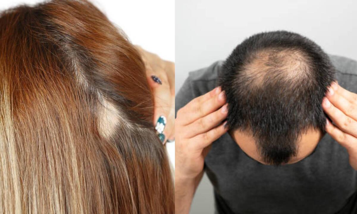 ¿Qué es lo más efectivo contra la alopecia?